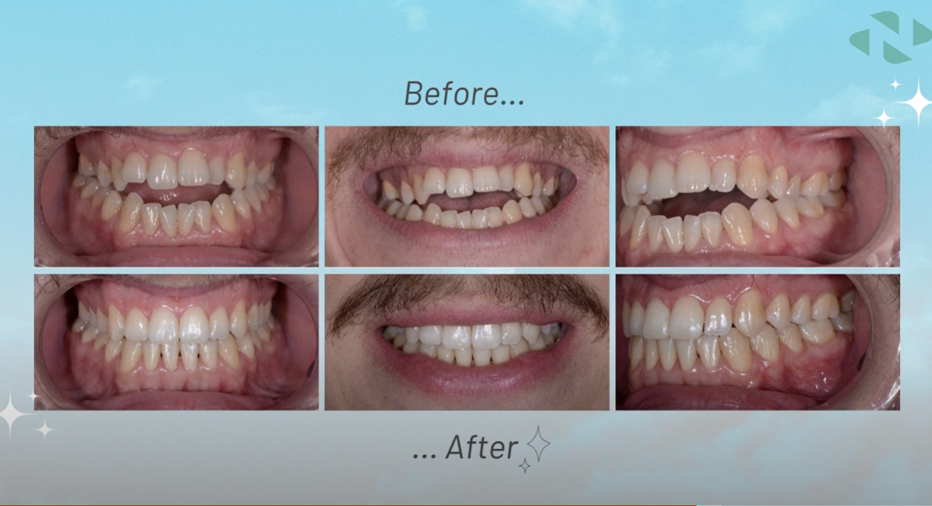 Nuvola before and after showing corrected crowding and bite