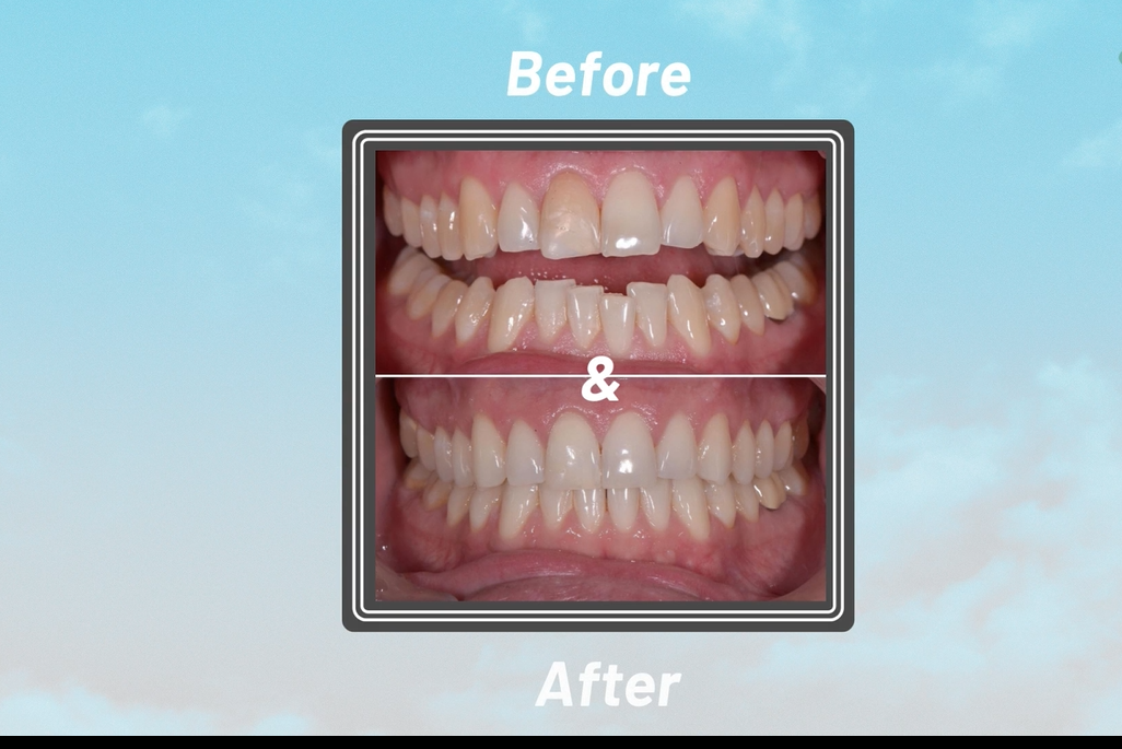 Nuvola before and after smile transformation