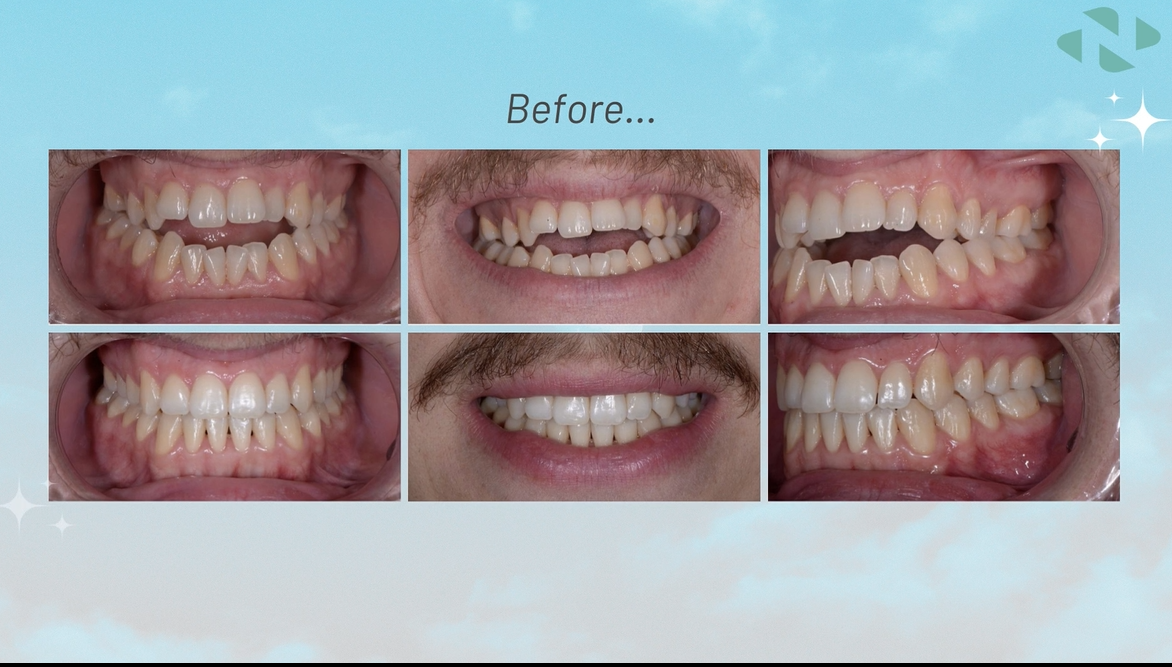 Nuvola aligner treatment before and after result